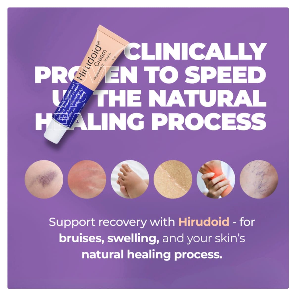 Thumbnail Hirudoid Cream for Bruises 40g