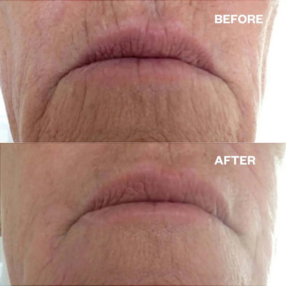 Thumbnail Wrinkles Schminkles Mouth & Lip Wrinkle Patch - 1 Pack