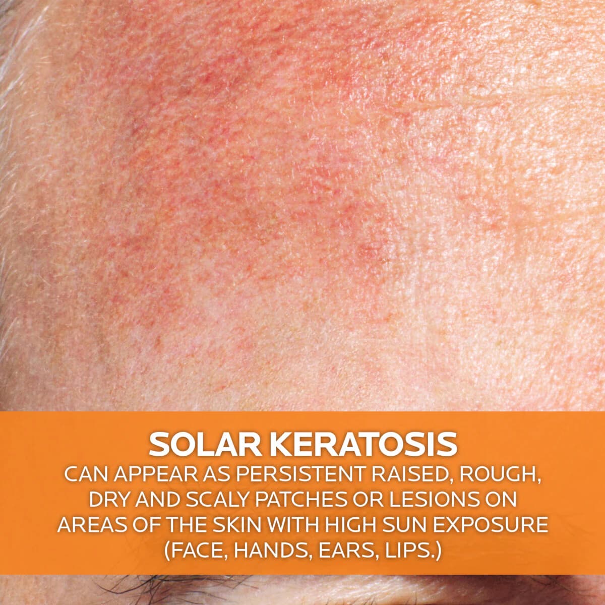 Thumbnail La Roche Posay Anthelios Ka+ Sunscreen SPF50+ 50mL